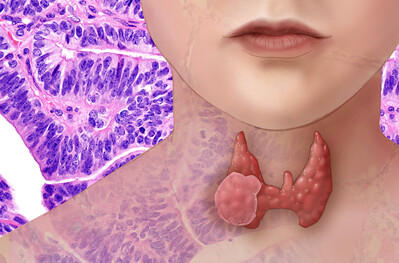 여성 목에 갑상선암이 그려져 있는 사진