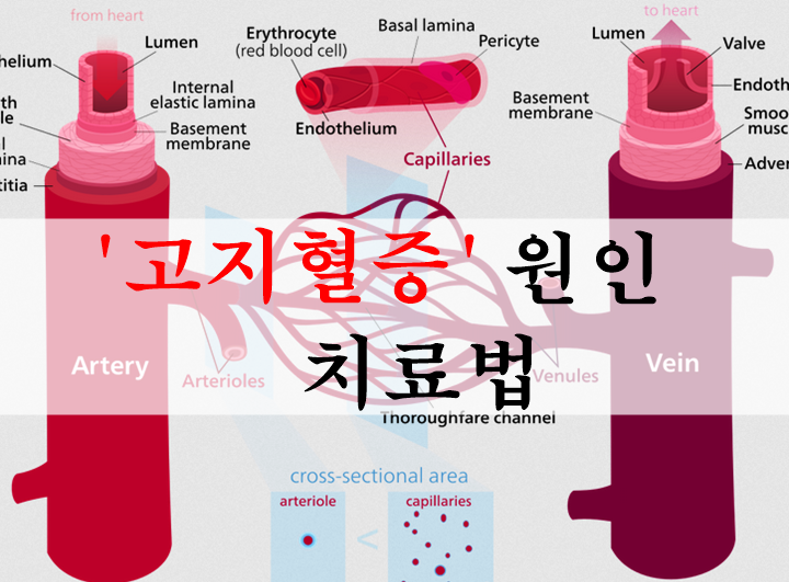 고지혈증 사진