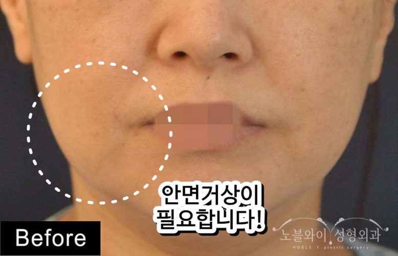  안면리프팅가격 낸만큼 효과는?