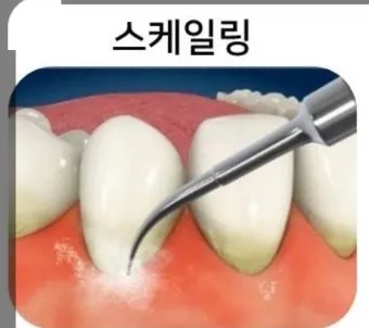 스케일링 후 양치 통증 음식_24
