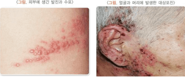 얼굴과-귀옆에-생긴-대상포진