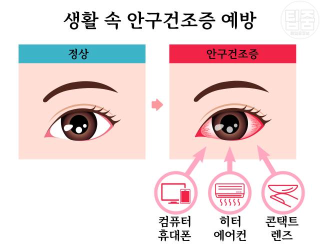 눈 따갑고 눈물 안구건조증 해결 눈뻑뻑함 이물감 눈건조증 원인
