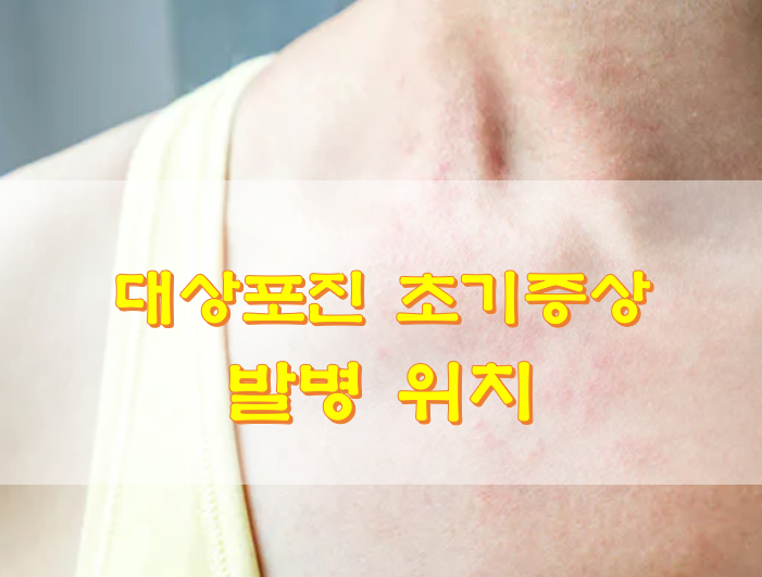  대상포진 초기증상 발병 위치 원인