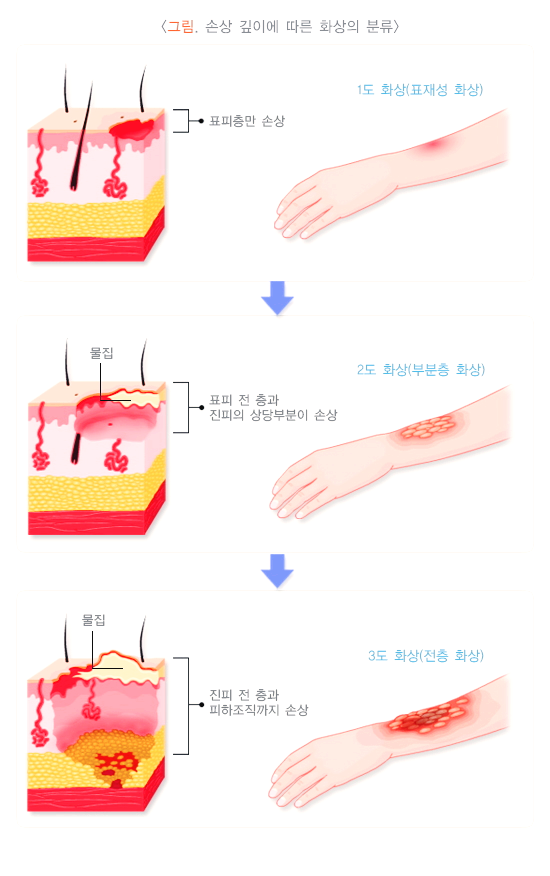 손상 깊이에 따른 화상 분류