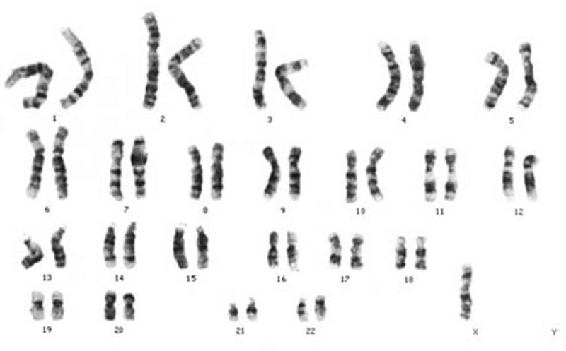클라인펠터-증후군-염색체-설명