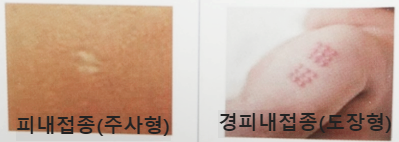 주사-형태-흉터