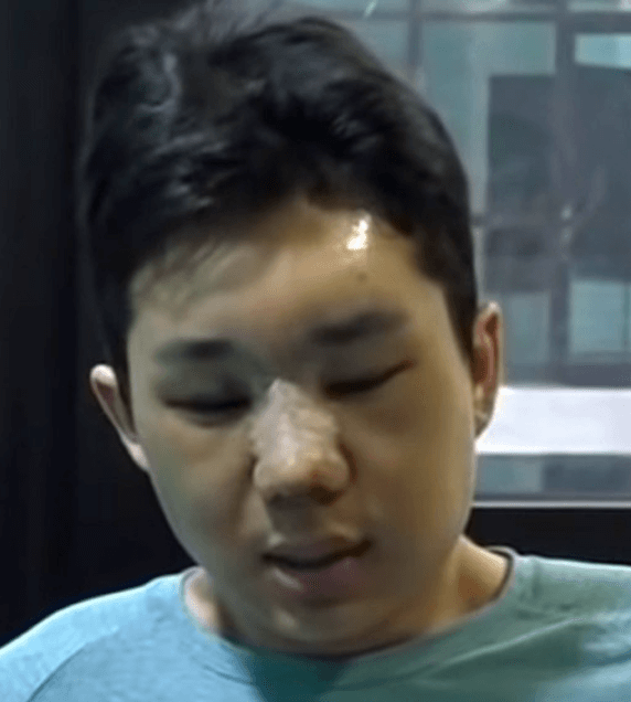  보겸 성형수술 이유
