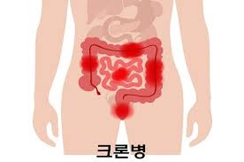  2030에서 많이 나타나는 '크론병'?