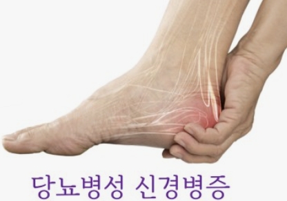 발바닥이 화끈거리는 이유 당뇨병성 신경병증