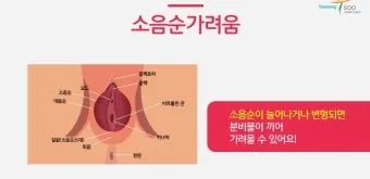 항문가려움 원인 치료방법 관리방법_25