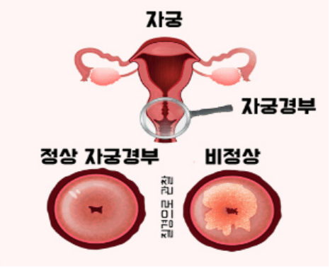 자궁경부암 검사방법 자궁경부암 검사비용