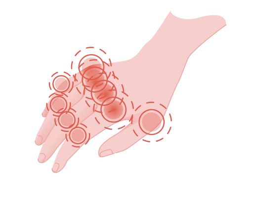 손가락마디통증