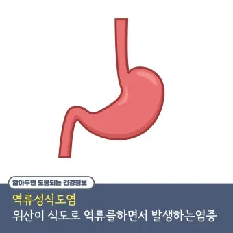 식도염에 좋은 음식 안좋은 음식_13