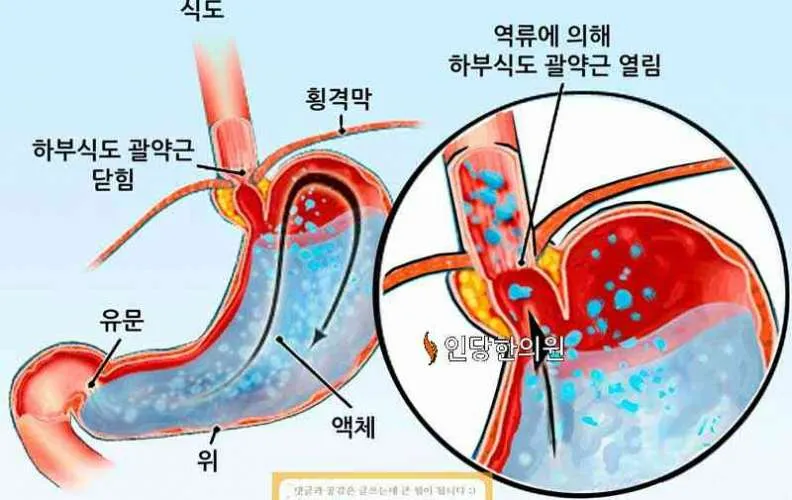 역류성 식도염 치료제