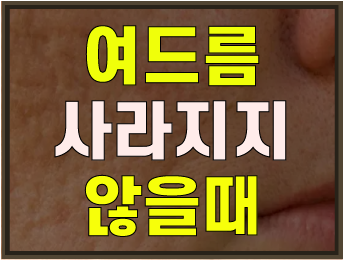  여드름 피부 관리법, 여드름이 사라지지 않을 때 할일!
