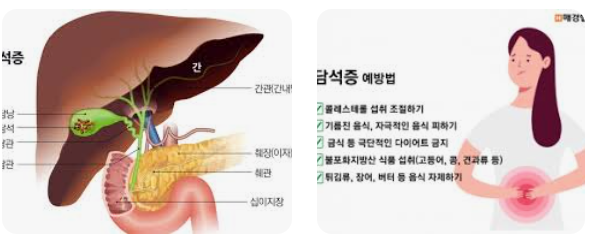 담석 용해 약물의 효과와 사용 시기