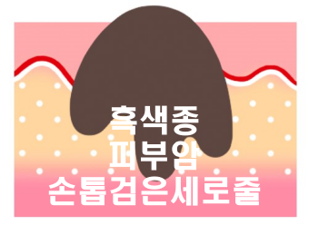 피부암 - 흑색종 - 모양 - 그림