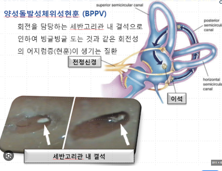 이석증 원인