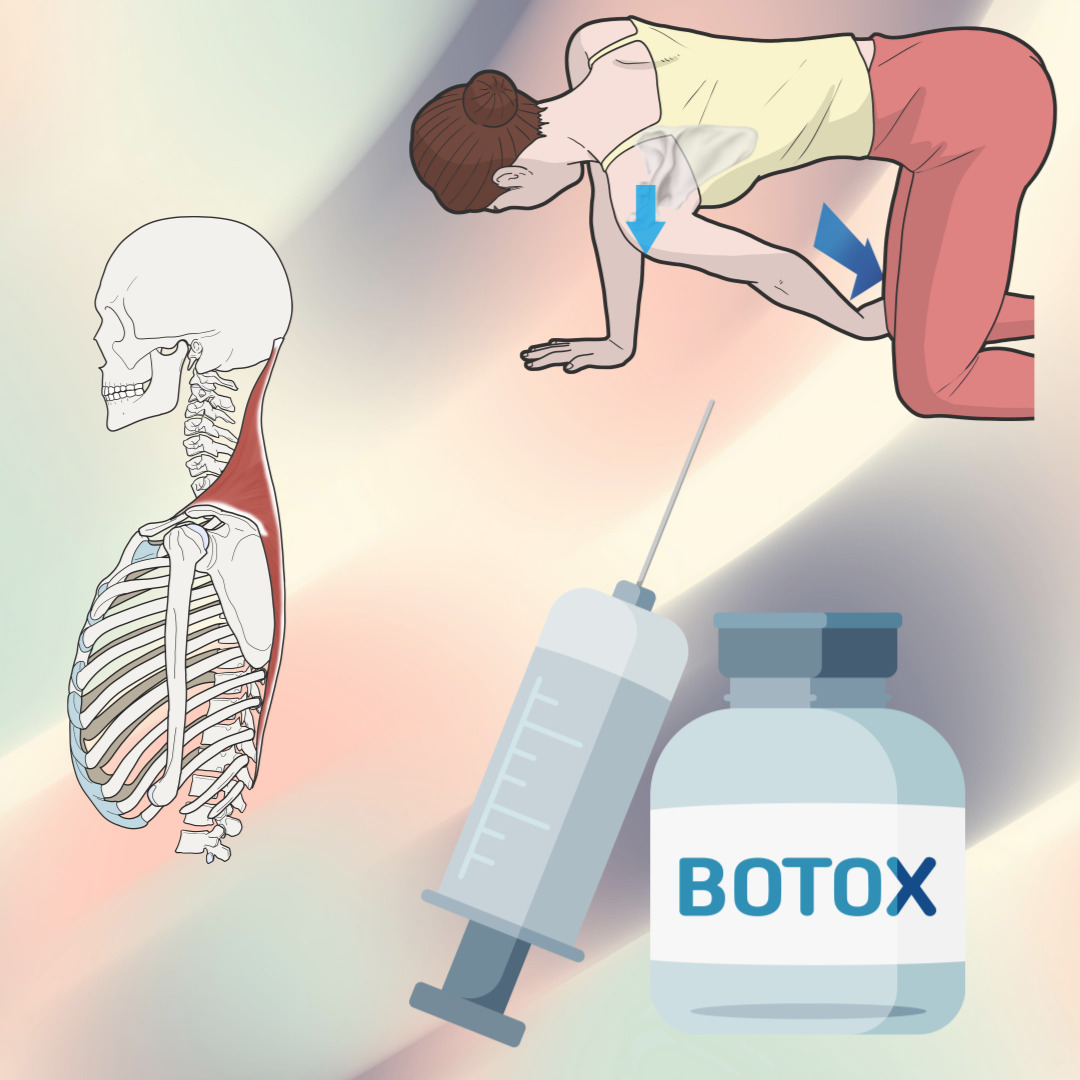 승모근 보톡스 관련 그림