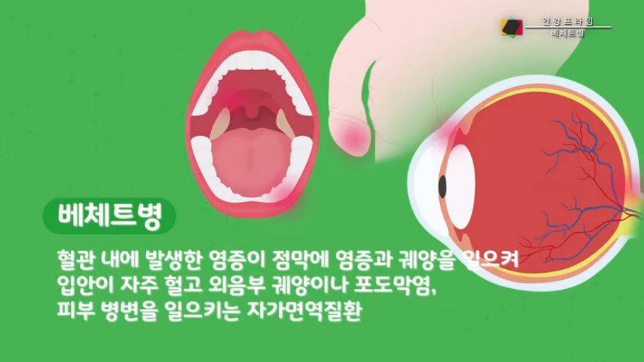  베체트병이란..베체트병에 좋은 음식