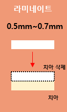 라미네이트 구조