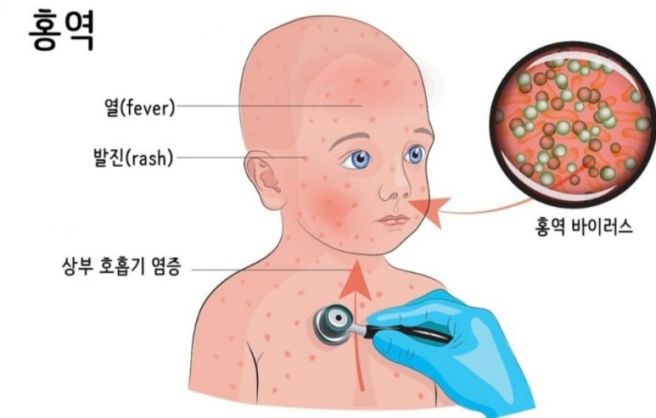홍역 증상