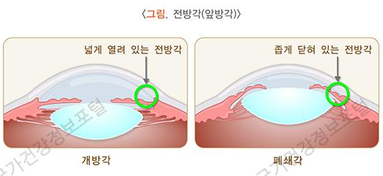 개방각-폐쇄각-녹내장의-전방각