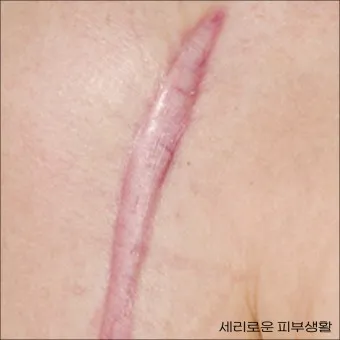 흉터전용 치료 추천 스카덤 겔 효능효과_4