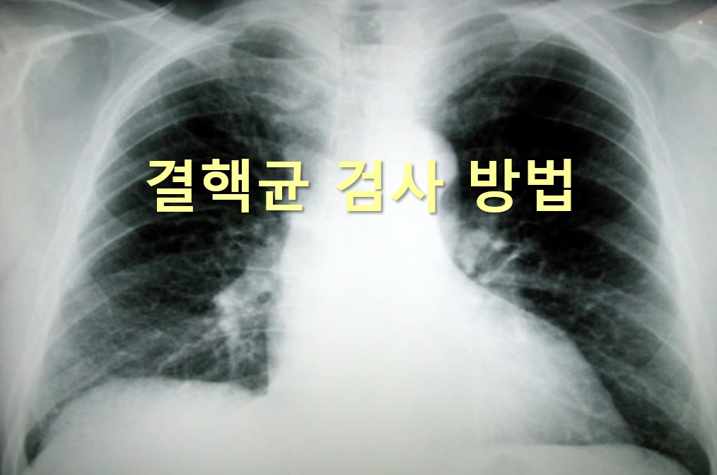  결핵을 진단하는 결핵균 검사 방법