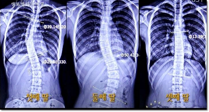  (생로병사의 비밀) 541회 척추측만증 유전 세자매