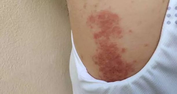 대상포진 초기증상 치료방법