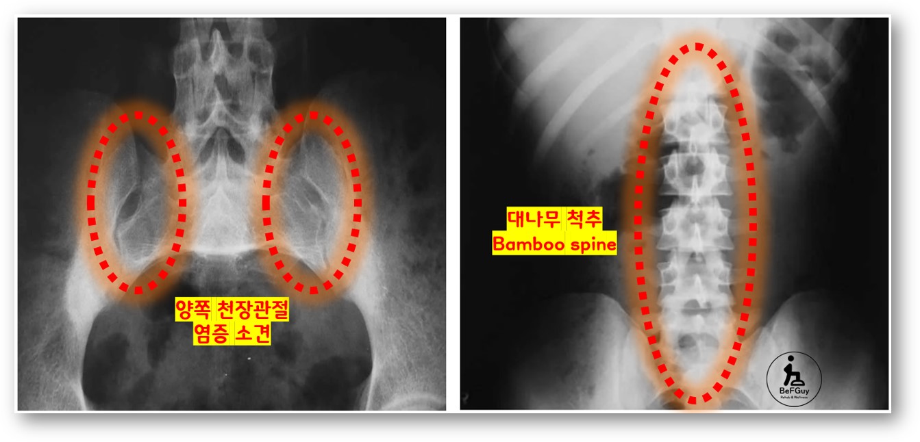 강직성 척추염 X-ray