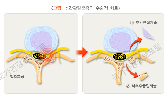 추간판 절제술/후궁 절제술