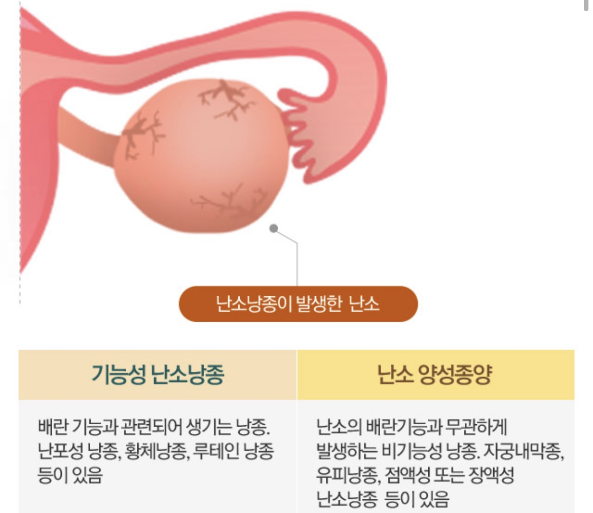 난소낭종의 원인