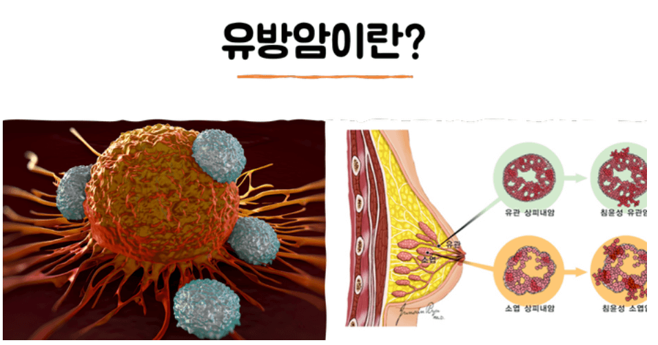 유방암 초기증상 검사비용 유방암 자가진단