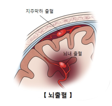 뇌출혈