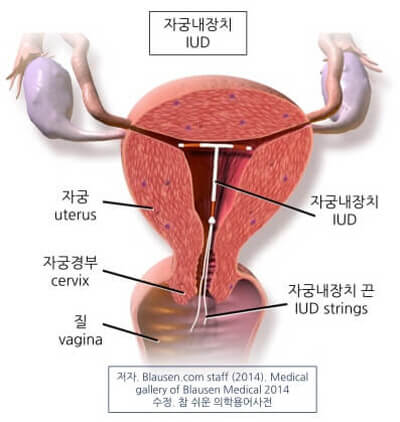 의학용어 IUD 뜻 intrauterine device 자궁내장치 수술시기와 부작용