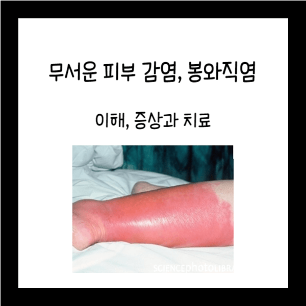  무서운 피부 감염, 봉와직염 : 이해, 증상과 치료
