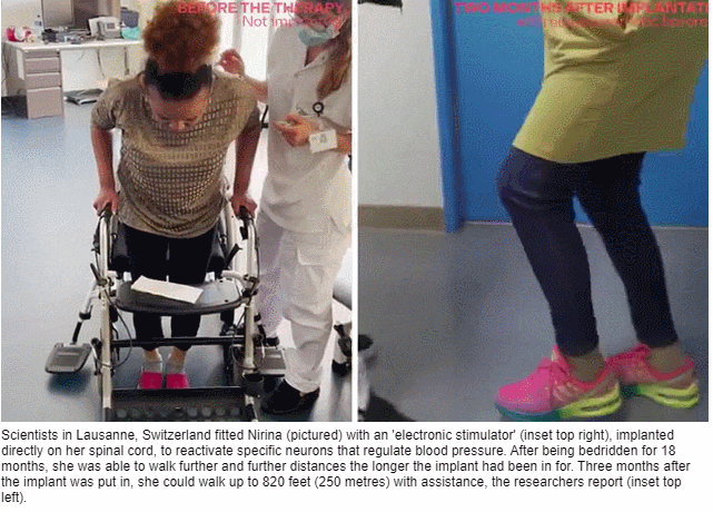  마비 환자를 걸을 수 있게 해주는 '척추 임플란트',  VIDEO: Woman able to walk for the first time in 18 months due to implant
