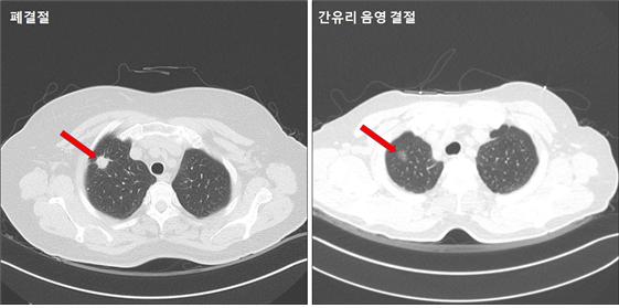 폐결절 간유리음영 결절