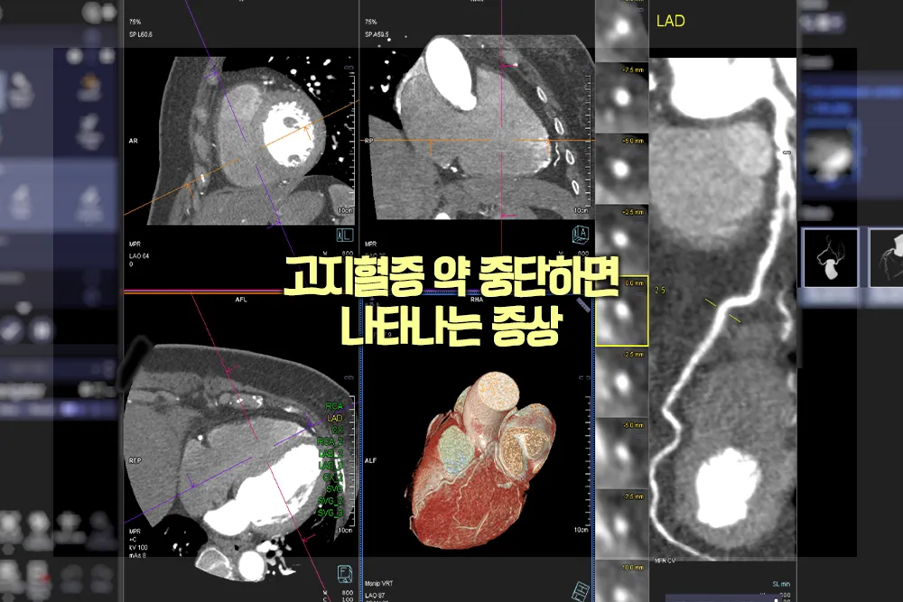 고지혈증 약 중단하면 나타나는 증상