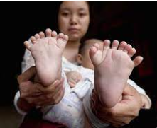 손&middot;발가락 26개로 태어난 인도 아기