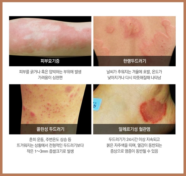 두드러기 종류