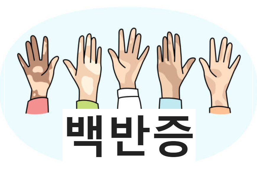  백반증 : 흰색 반점이 생겨 퍼져나가는 후천적 만성 피부 질환