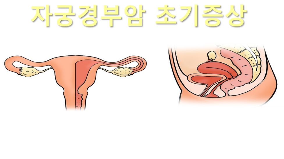  자궁경부암 초기증상과 자궁경부암 치료 방법
