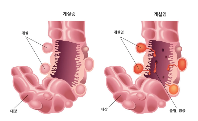 게실염과 게실 출혈