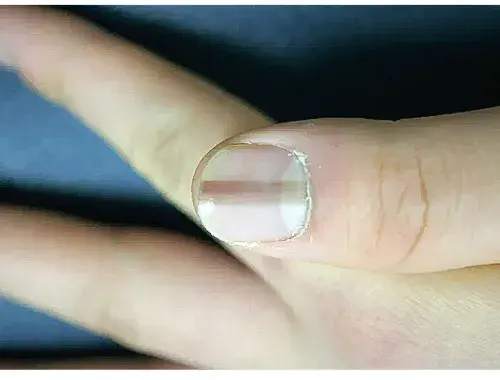 상처-회복-과정에서-발생하는-손톱-검은줄