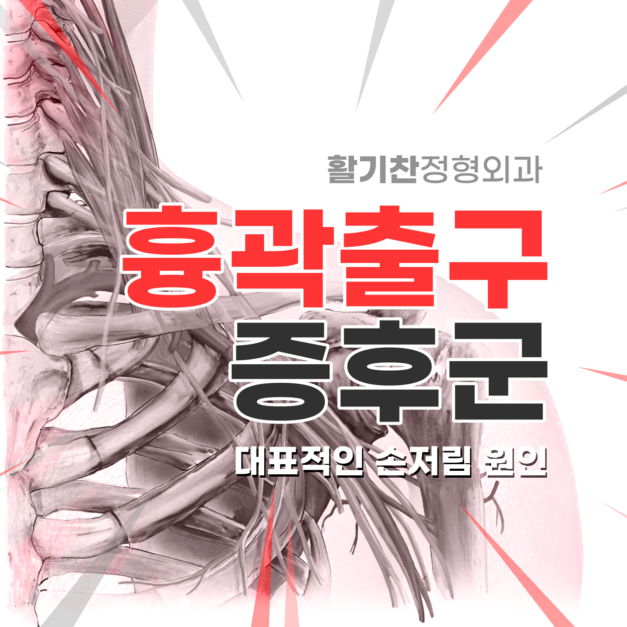  구산동정형외과, 목디스크가 아닌 흉곽출구증후군(TOS) 이라고?