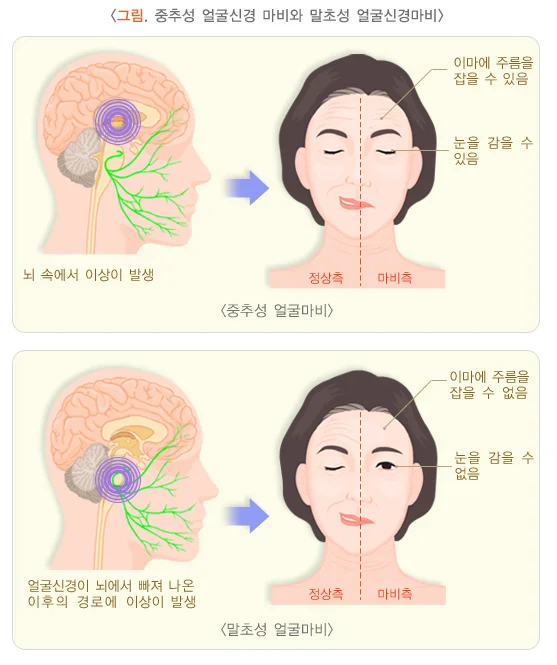 얼굴마비
얼굴신경마비
얼굴 말초성 마비
벨마비