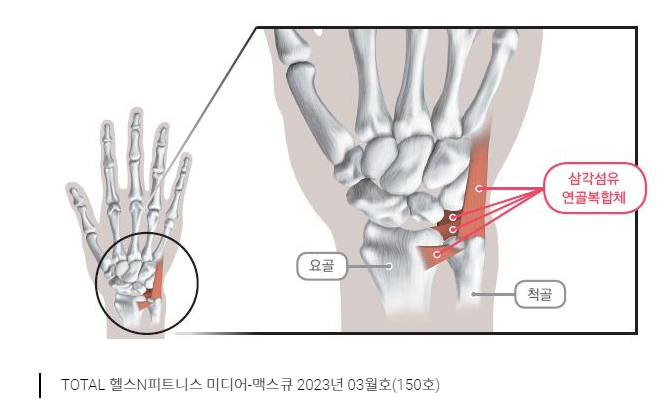 손목통증-삼각섬유연골복합체-TFCC